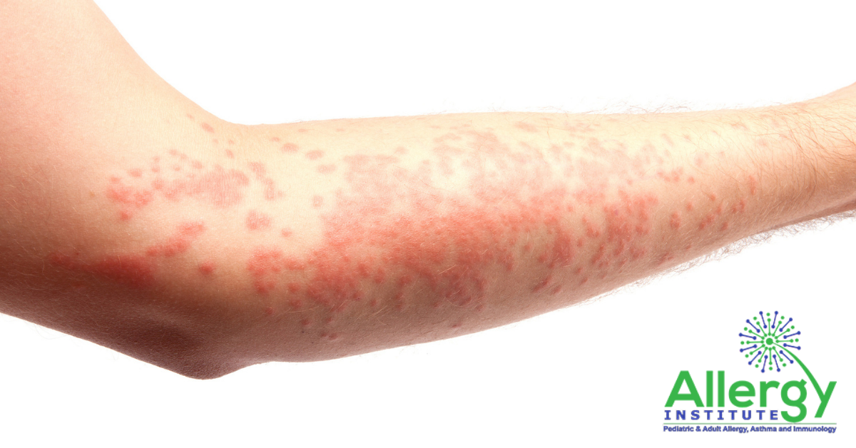 How to Itchy Hives | Allergy Institute PC